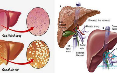 Cậu bé 6 tuổi bị gan nhiễm mỡ, nguyên nhân do các loại đồ ăn hầu hết trẻ đều thích