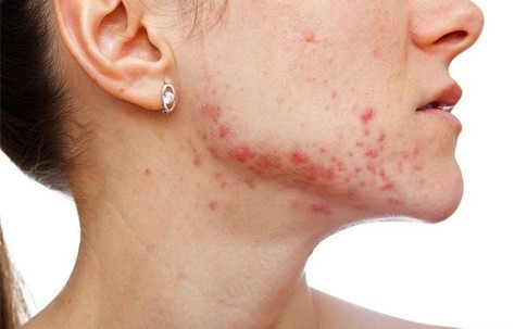 Dù kết hợp nguyên liệu gì với mật ong cũng có thể chế ra "thần dược" trị mụn