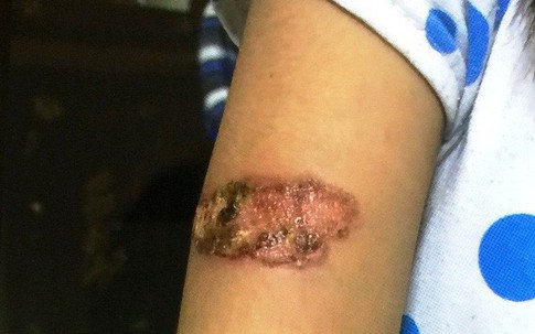 Vụ bé gái nghi bị dí sắt nung: Mẹ ruột kiện đòi quyền nuôi con