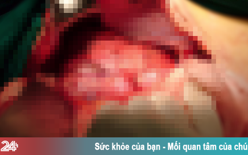 Cắt bướu vỏ bao thần kinh sau phúc mạc nặng hơn 2,2kg