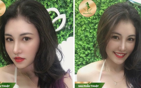 Cơn sốt nâng mũi Sform tại TMV Sài Gòn Venus