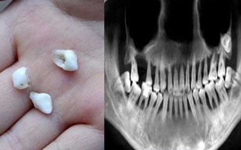 Cô gái 28 tuổi rụng răng, móm mém như cụ bà 80 vì thói quen xấu