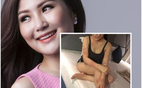 Ca sĩ Hương Tràm nổi mẩn, ngứa: Chứng dị ứng gây nguy hiểm lớn mức nào nếu chủ quan?