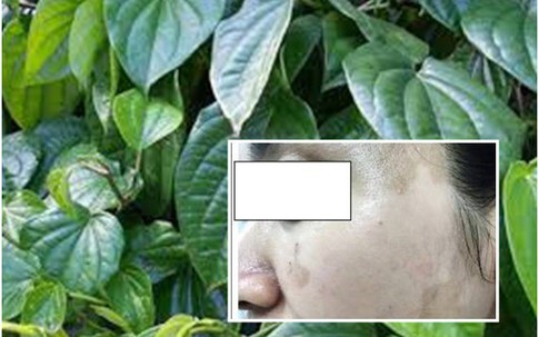 Gặp họa vì làm đẹp da mặt đón Tết bằng đắp lá trầu không