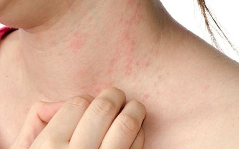 Khổ sở vì mẩn ngứa cả đêm do bệnh viêm da cơ địa