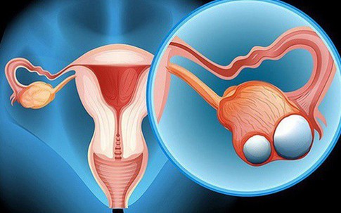 Cô gái 23 tuổi chưa kết hôn đã bị ung thư dạ dày di căn buồng trứng, cảnh báo những thói quen xấu nhiều người mắc