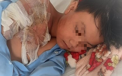 Cháu bé 11 tuổi bị cha ruột tạt nước sôi vào người gây bỏng nặng