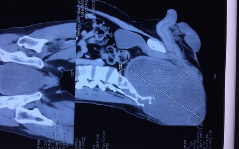 Người đàn ông Hà Nội suốt 1 năm chỉ... nằm sấp