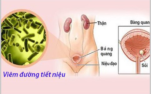 Viêm đường tiết niệu tái phát nhiều người chủ quan nhưng không lường trước được hậu quả đáng sợ thế nào