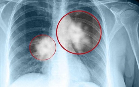 Thủ phạm trong nhà bếp khiến 2 vợ chồng bị ung thư, bác sĩ cảnh báo mọi người chú ý