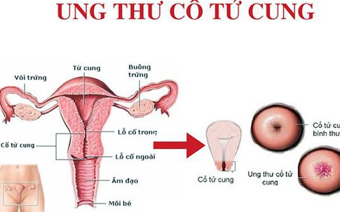 Ung thư cổ tử cung: Phòng tránh hiệu quả với các kĩ thuật sàng lọc này?