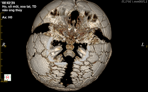 Bé trai 1 tuổi mắc bệnh cực hiếm, một vùng đầu không xương, 1 triệu ca mới có 1