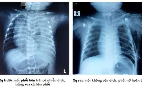 Bé trai mắc bệnh bẩm sinh khó chữa