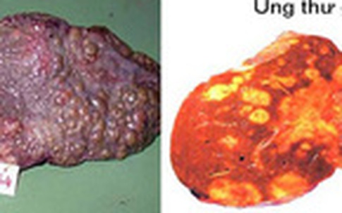 Nam thanh niên trẻ mắc ung thư gan, ân hận vì loại đồ uống mê mẩn