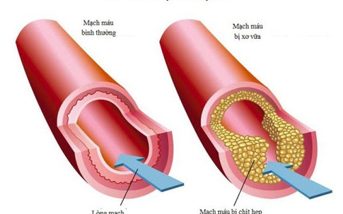 Lipidcleanz - Giải pháp giảm cholesterol, hạ mỡ máu hiệu quả!