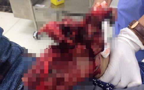 Cậu bé dập nát tay chân khi học làm pháo