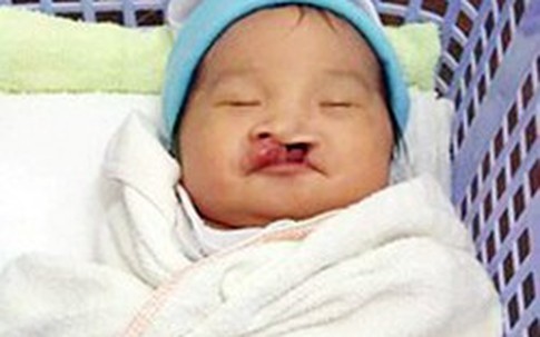 Bé gái sơ sinh hở hàm ếch bị bỏ rơi giữa chợ