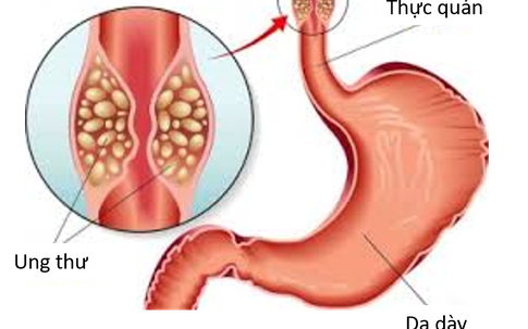 Đại tá bác sĩ Viện 108: Nhiều người Việt đang có thói quen gây ra loại ung thư phổ biến top đầu