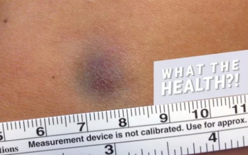 Vết bầm tím trên da người phụ nữ này suốt bao năm hóa ra là dấu hiệu cảnh báo bệnh cực nguy hiểm!