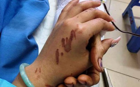 Nạn nhân bị tạt axit ở Quảng Ngãi: 'Tôi cứ tưởng là cướp'