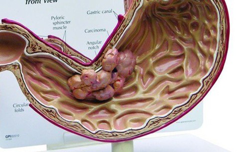 5 anh em nhưng 4 người bị ung thư dạ dày, 'sát thủ' ở ngay trong chính bữa ăn