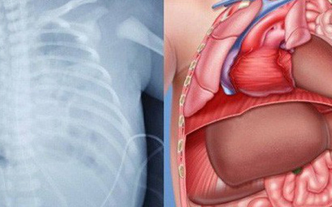 Phẫu thuật thoát vị cơ hoành bẩm sinh cho trẻ 2 ngày tuổi