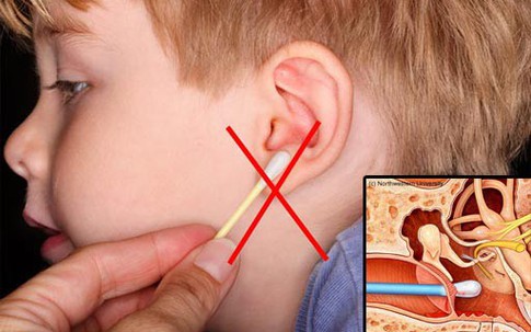 Từ vụ nhiễm trùng não do dùng tăm bông ngoáy tai, bác sĩ chỉ cách vệ sinh tai an toàn, hiệu quả