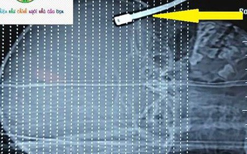 Hãi hùng thanh sắt xuyên vào ổ mắt, vô não bé 5 tuổi