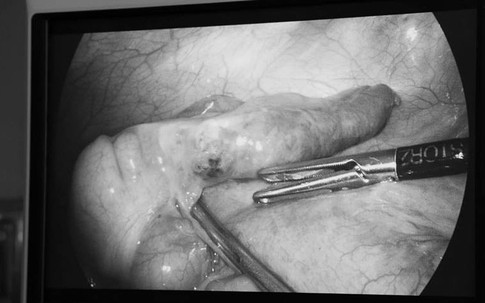 Phẫu thuật ruột thừa, bác sĩ ngạc nhiên phát hiện xương cá đâm xuyên thành ruột hiếm gặp