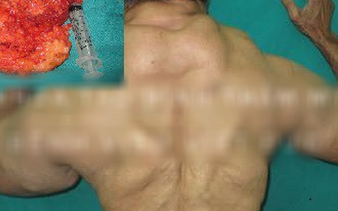 Người đàn ông có thân hình đồ sộ như lực sĩ vì... u mỡ