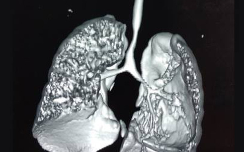 Phẫu thuật tim kết hợp tạo hình khí quản cho bé trai 11 tháng tuổi