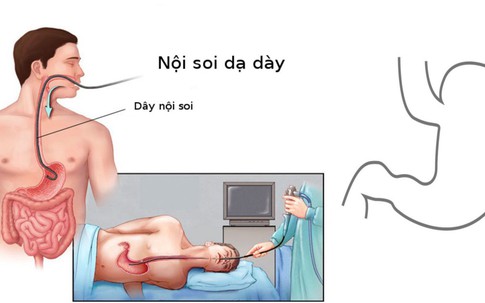 Người Việt dễ mắc ung thư dạ dày, cách nào phát hiện sớm?