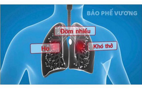 Ho, đờm kéo dài do viêm phế quản phải làm sao?