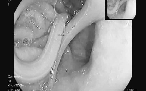 Hoa mắt, chóng mặt, cụ bà Hà Nội choáng vì nuôi béo mẫm loại ký sinh trùng này trong ruột