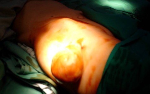 Giải phóng khối u to gần bằng quả bưởi ở “vùng nhạy cảm” cho nữ bệnh nhân ở Hà Nội
