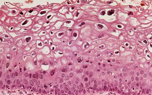 Vắc-xin HPV giúp giảm đáng kể nguy cơ ung thư cổ tử cung
