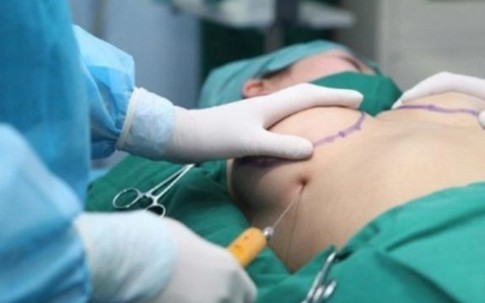 Mạch máu phun trào trong ngực nữ doanh nhân sau khi nâng vòng 1 ở nước ngoài