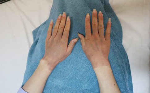 Quảng Ninh: Chùm bóng bay chứa khí hydro phát nổ, 4 thanh niên nhập viện