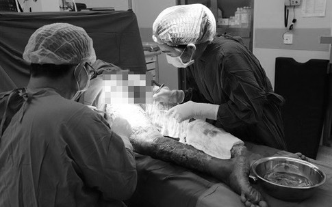 Bỏ qua vết xước nhỏ, cô giáo suy thận sau khi làm thịt lợn