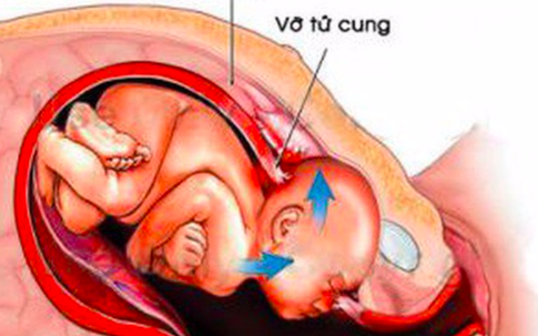 Thai phụ 20 tuổi "khiếp đảm" khi nghe bác sĩ nói đã vỡ tử cung sau cú ngã tại nhà