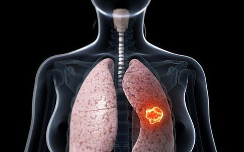 Giám đốc BV Ung bướu: Ung thư phổi khó phát hiện, nhưng có dấu hiệu này thì đến viện ngay