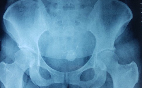 Người đàn bà 34 tuổi bị "dị vật chui vào người" mà không biết