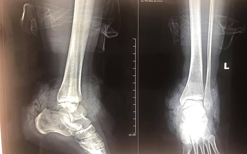 Nối cổ chân bị đứt lìa cho cô giáo mầm non bị tai nạn rợn người