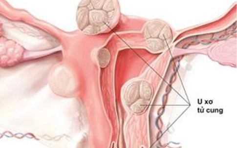 Phụ nữ nên tránh 7 loại thực phẩm hại tử cung, ăn vào chẳng khác gì "nuôi" khối u