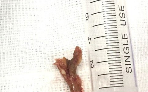 Gắp xương cá "làm tổ" 3 tháng trong phế quản người đàn ông