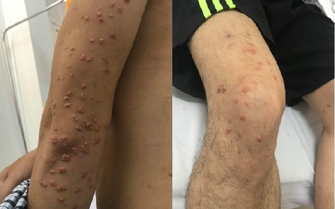 Bỗng nhiên nổi dày đặc nốt trên da, sụt cân không phanh, phát hiện u phát ban