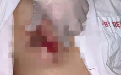 Ngực đau nhức, chảy mủ dịch, thâm tím sau bơm ngực ở spa tại Hà Nội
