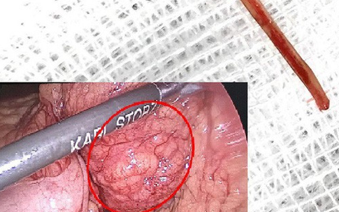 Tưởng đau bụng do rối loạn tiêu hóa, vào viện phát hiện xương cá đâm thủng ruột