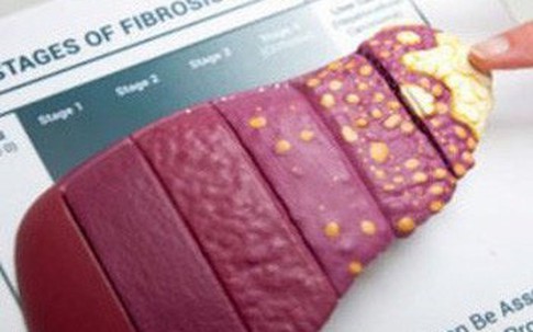 4 anh em một nhà bị ung thư, 3 người chết sau 10 năm vì chủ quan với điều này