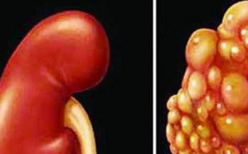 Ung thư thận: Dấu hiệu khi đi tiểu tiện nếu gặp cần khám ngay kẻo muộn